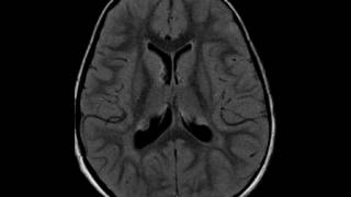 Tuberous Sclerosis [upl. by Liliane256]