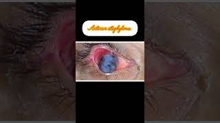 staphyloma structure type youtube viral videos [upl. by Renard]