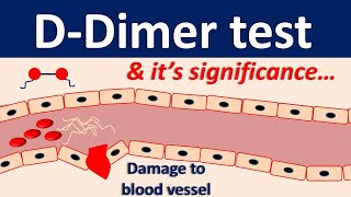 Ddimer test and its significance [upl. by Felisha]