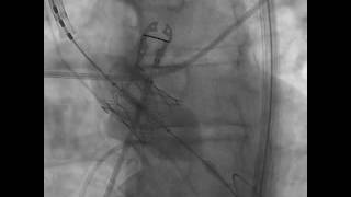 TAVR Implantation Aortogram under Fluoroscopic Guidance SAPIEN 3 [upl. by Olnton676]