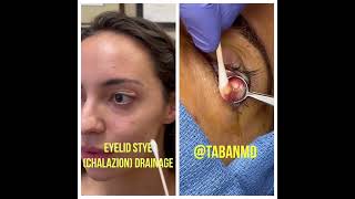 Scarless chalazion drainage [upl. by Demmahom]