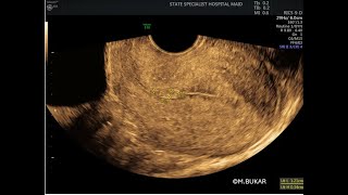 SMALL ENDOMETRIAL POLYP [upl. by Malory]