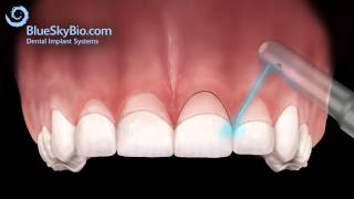 Patient Treatment Videos Gingivectomy [upl. by Walls]