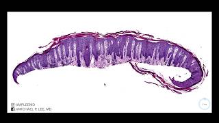 Psoriasis versus nummular dermatitis Dermpath made easy [upl. by Padraig]