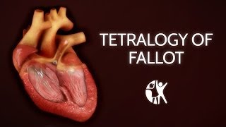 Tetralogy of Fallot  Cincinnati Childrens [upl. by Aihseyk]