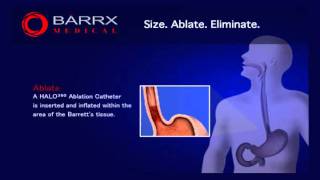 BARRX Medical HALO360 ablation technology [upl. by Eniahs]