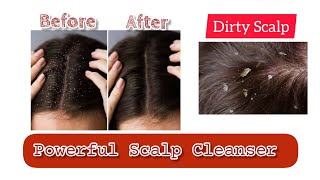 DIY Scalp Scrub Scalp cleanser for flaky Scalp [upl. by Schmitt]