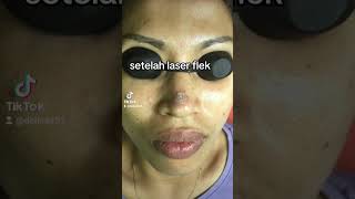 LASER FLEK UNTUK FLEK HITAM DI WAJAH [upl. by Ylen326]