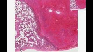 Histopathology Lung Recent infarct [upl. by Modestine417]