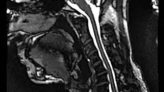 Live Motion MRI of the Neck During Movement  Bloomingdale IL Chiropractor  Ducat Chiropractic [upl. by Ibocaj]