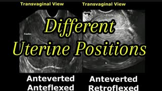 Uterine Positions In Ultrasound  AntevertedRetroverted  AnteflexedRetroflexed Uterus [upl. by Burnett]