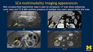 Imaging pancreatic cyst [upl. by Manda834]