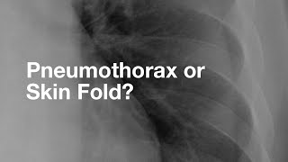 Pneumothorax vs Skin Fold [upl. by Zachary846]