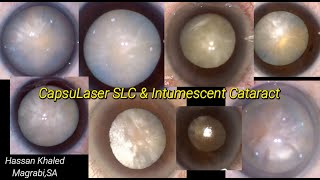 CapsuLaser SLC amp Intumescent Cataract  8 Cases [upl. by Zennie]