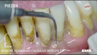 Guided Biofilm Therapy Step 06 Calculus removal with PIEZON® and the PS instrument [upl. by Iene]