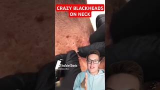 Crazy BLACKHEADS REMOVAL FROM NECK  Dont Try This At Home shorts [upl. by Almund]