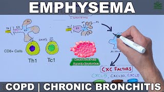 Emphysema  COPD [upl. by Eadahc]