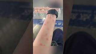 Terrifying psoriasisFrequent itching psoriasis [upl. by Queri]