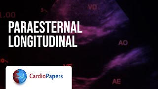 Paraesternal longitudinal [upl. by Zuliram]