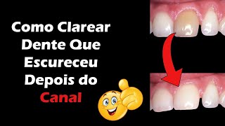 Como Clarear Dente Que Ficou Escuro Depois do Tratamento De Canal  Canal Deixa Dente Escuro [upl. by Strephon]