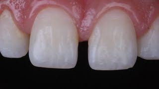 diastema closure with composite resin [upl. by Mccomb]