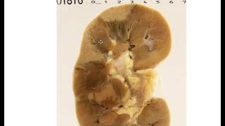 Renal infarct Gross pathology [upl. by Sillek]