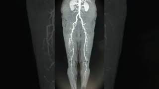 CT angiography of lower limbvairalvideo radiological humanbody anatomy [upl. by Leyes]