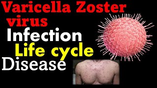 Varicella zoster virus pathogenesis  chickenpox virus [upl. by Eyaj]