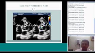 Pedicardio classes on Echocardiography in Fallots Tetralogy by Dr Ashutosh Marwah [upl. by Pyotr]