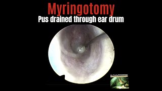 Endoscopic MyringotomyPus drained from middle ear by puncturing the eardrum [upl. by Na683]