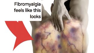 Fibromyalgia at its Worst [upl. by Gerrald]