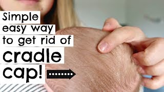 HOW TO GET RID OF CRADLE CAP IN ONE TRY  NEWBORN [upl. by Gudren]