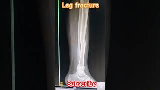 Left Leg 🦵 AP lateral view Xray shorts viral medical student trending craft me [upl. by Kcirddec]