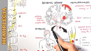 Hemiplegia part 1  causes pathophysiology stages and manifestations [upl. by Cook790]