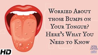 Worried About Those Bumps on Your Tongue Heres What You Need To Know [upl. by Zacharia]