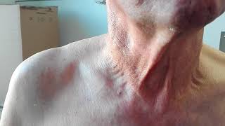 Lancisi sign in both external jugular veins [upl. by Calla]