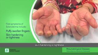 What is Scleroderma also known as Systemic Sclerosis [upl. by Byler158]