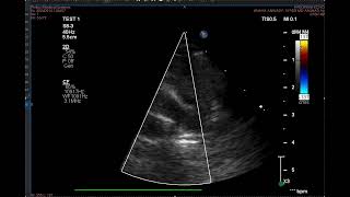 Branch pulmonary artery stenosis critical [upl. by Fadas221]