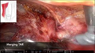 Robotic eTEP TAR with BTA injection for Complex and Loss of domain Ventral hernia Tips and Tricks [upl. by Aika290]