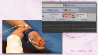 Motoric Neurography  Median Nerve [upl. by Nodnek]