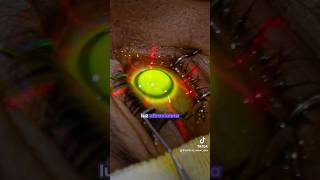 Cirugía de crosslinking corneal ¿ya la conocías  👈🏻👁️ [upl. by Teahan746]