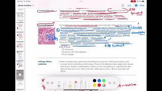 carcinoid Tumours endocrinology 82  First Aid USMLE Step 1 in UrduHindi [upl. by Eniruam738]