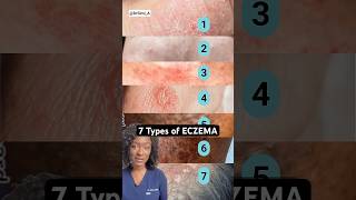 7 Eczema Types How to Tell Which One You Have [upl. by Elorak]