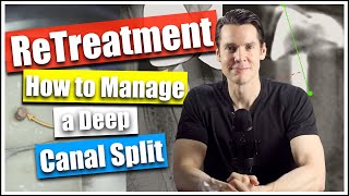 Root Canal Retreatment How Manage a Deep Canal Split Dr William Nudera Endodontist [upl. by Ythomit]