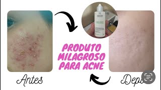 Loção secativa ADCOS  meu tratamento para acne [upl. by Aciamaj]