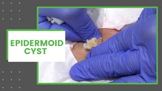 Epidermoid Cyst  Dr Derm [upl. by Lou55]