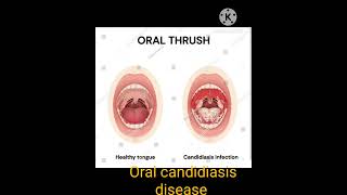 Oral candidiasis disease [upl. by Krutz332]