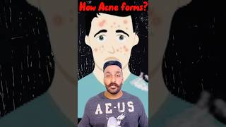 How Acne forms  Zeerak Akbar [upl. by Rimas]