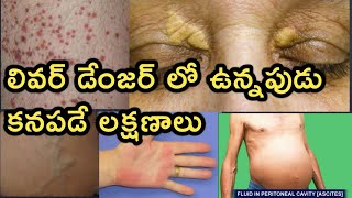 Liver Disease and Symptoms Detailed Video in Telugu [upl. by Dviad]