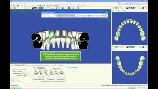 Occlusal Contacts with High Level of Precision  part 11 [upl. by Morrissey]